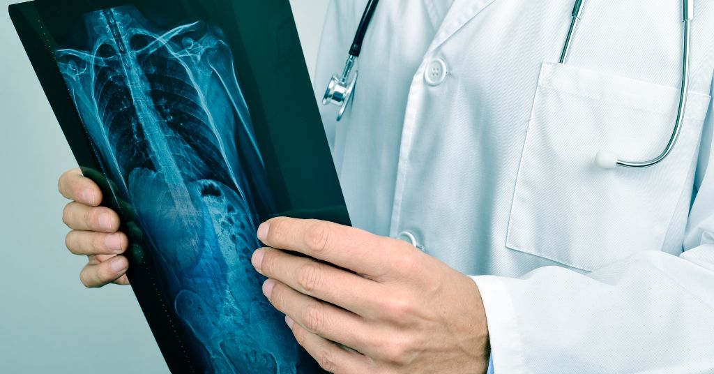 Invalidità civile e cisti di Tarlov? Nella foto: un medico studia la lastra di una radiografia alla colonna vertebrale.
